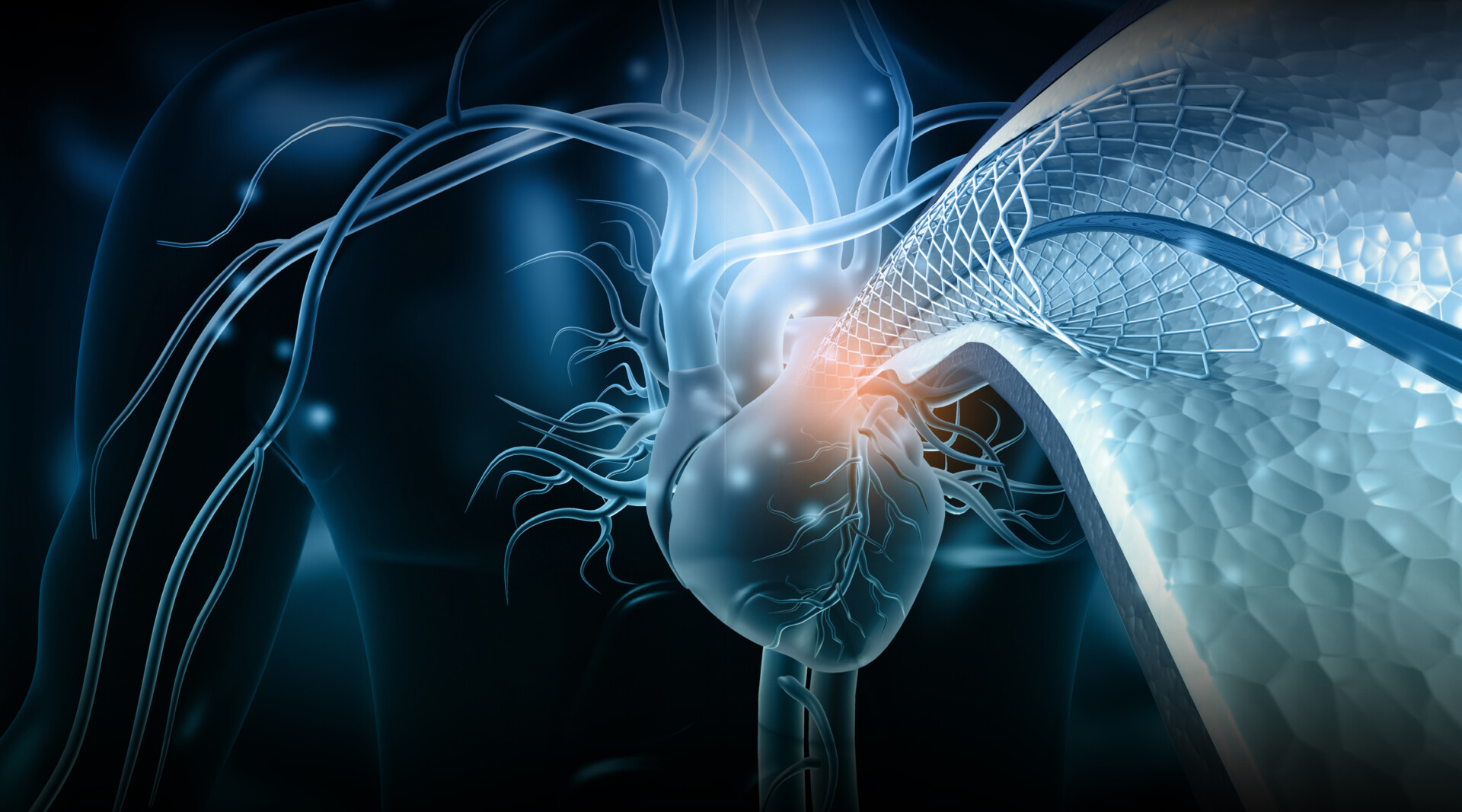nevrovascular malformations